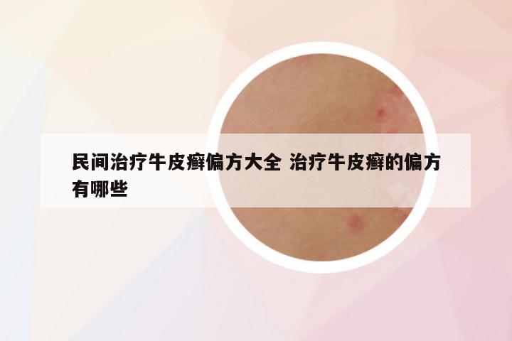 民间治疗牛皮癣偏方大全 治疗牛皮癣的偏方有哪些