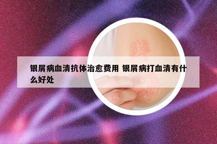银屑病血清抗体治愈费用 银屑病打血清有什么好处