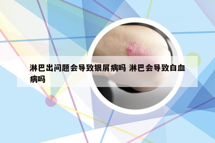 淋巴出问题会导致银屑病吗 淋巴会导致白血病吗