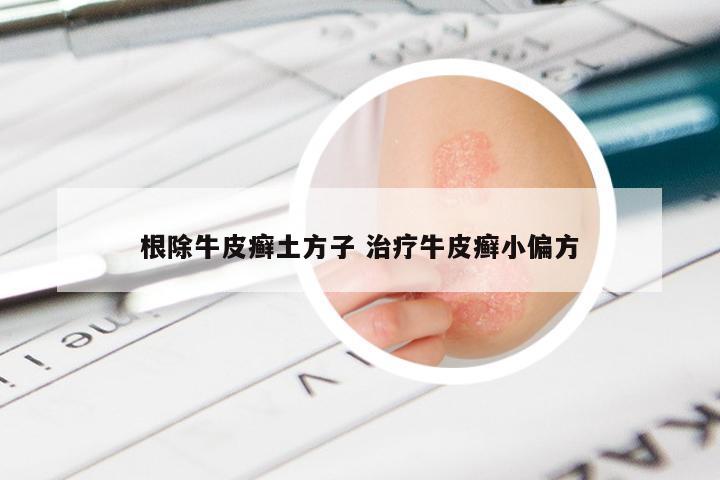 根除牛皮癣土方子 治疗牛皮癣小偏方