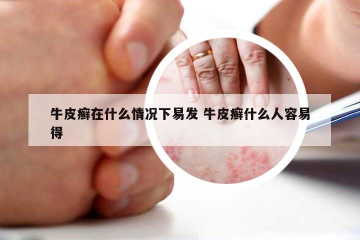 牛皮癣在什么情况下易发 牛皮癣什么人容易得