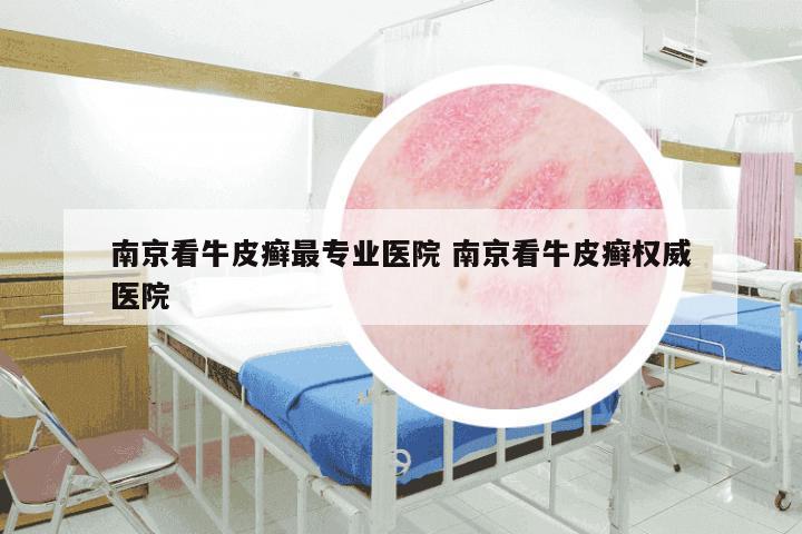 南京看牛皮癣最专业医院 南京看牛皮癣权威医院