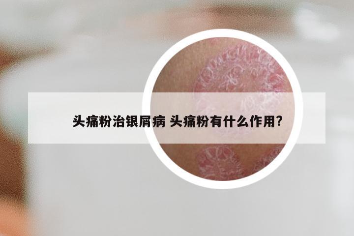 头痛粉治银屑病 头痛粉有什么作用?