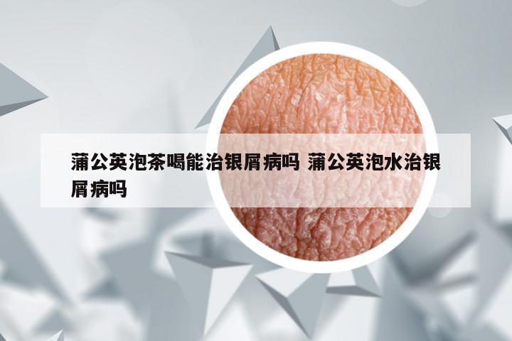 蒲公英泡茶喝能治银屑病吗 蒲公英泡水治银屑病吗