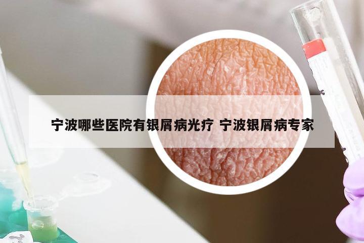 宁波哪些医院有银屑病光疗 宁波银屑病专家