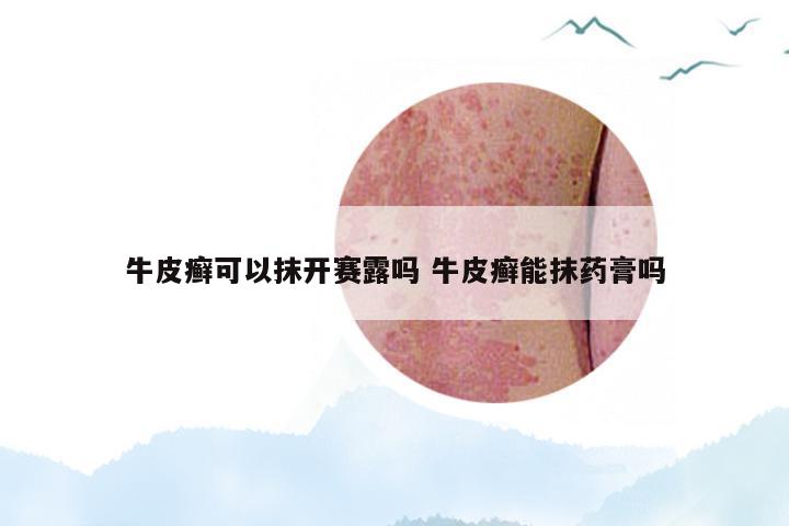 牛皮癣可以抹开赛露吗 牛皮癣能抹药膏吗