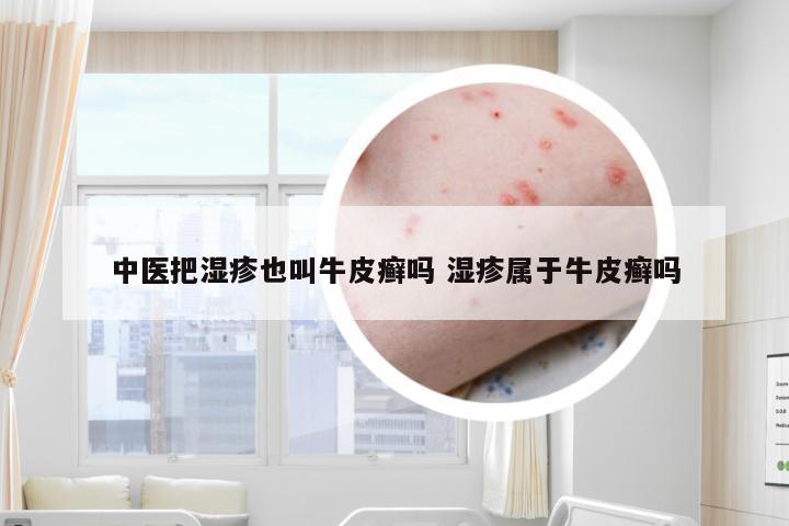 中医把湿疹也叫牛皮癣吗 湿疹属于牛皮癣吗