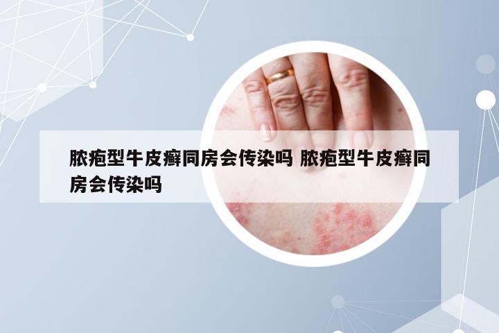 脓疱型牛皮癣同房会传染吗 脓疱型牛皮癣同房会传染吗