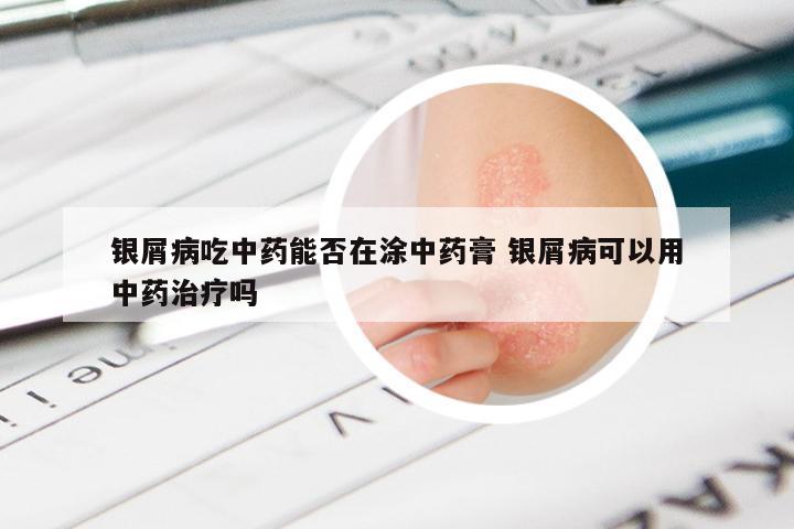 银屑病吃中药能否在涂中药膏 银屑病可以用中药治疗吗