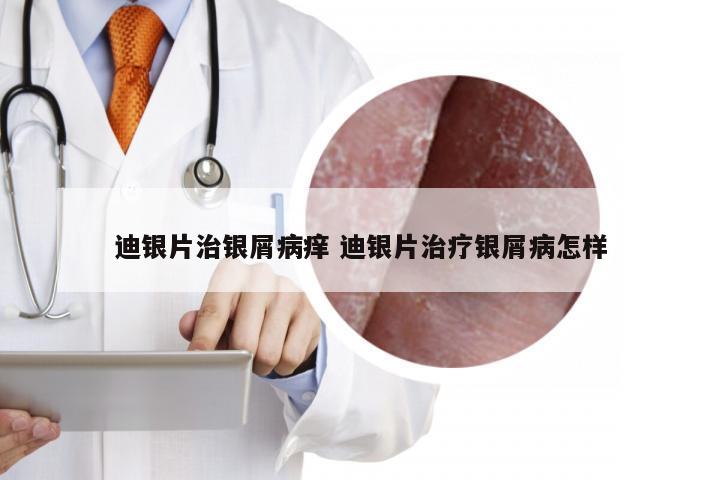 迪银片治银屑病痒 迪银片治疗银屑病怎样