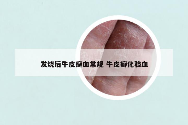 发烧后牛皮癣血常规 牛皮癣化验血