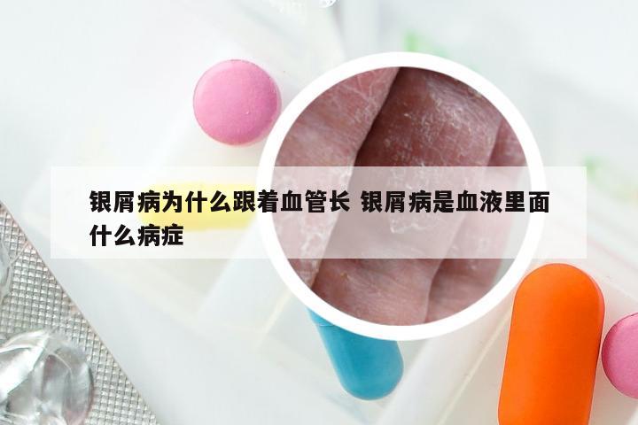 银屑病为什么跟着血管长 银屑病是血液里面什么病症