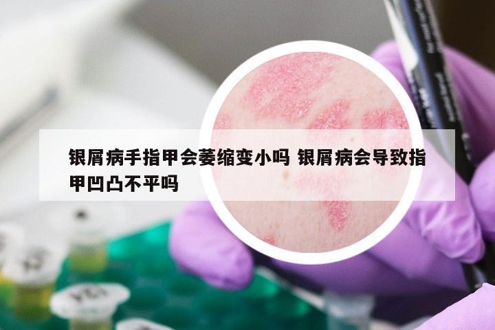 银屑病手指甲会萎缩变小吗 银屑病会导致指甲凹凸不平吗