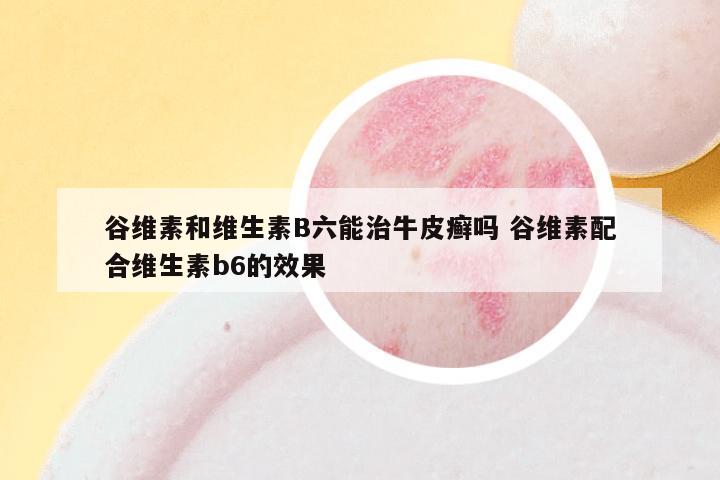 谷维素和维生素B六能治牛皮癣吗 谷维素配合维生素b6的效果