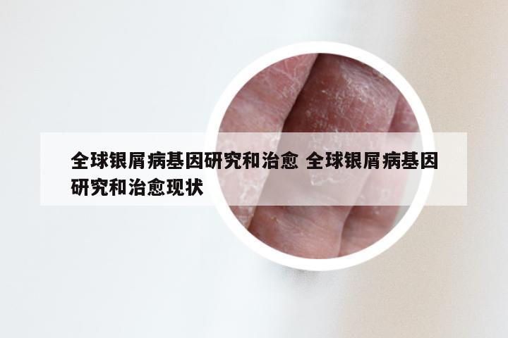 全球银屑病基因研究和治愈 全球银屑病基因研究和治愈现状