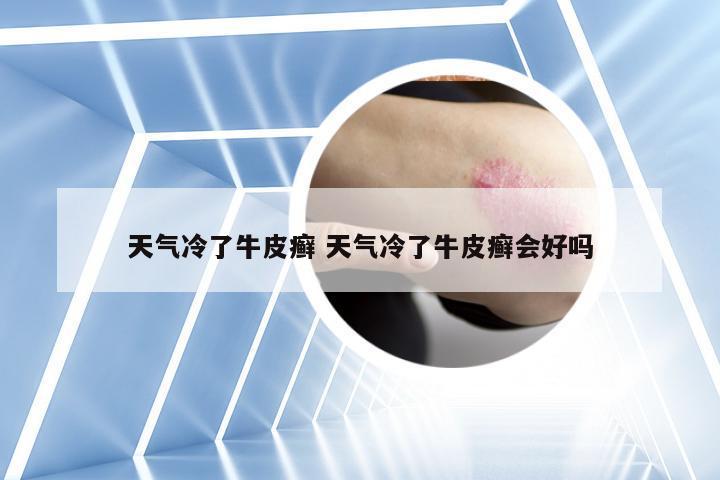 天气冷了牛皮癣 天气冷了牛皮癣会好吗