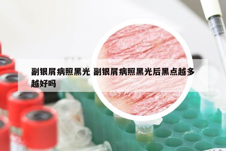 副银屑病照黑光 副银屑病照黑光后黑点越多越好吗