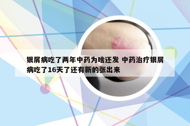 银屑病吃了两年中药为啥还发 中药治疗银屑病吃了16天了还有新的张出来