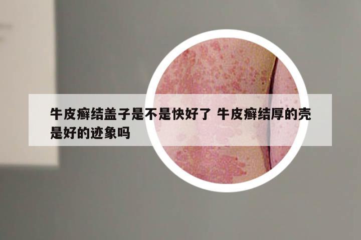 牛皮癣结盖子是不是快好了 牛皮癣结厚的壳是好的迹象吗
