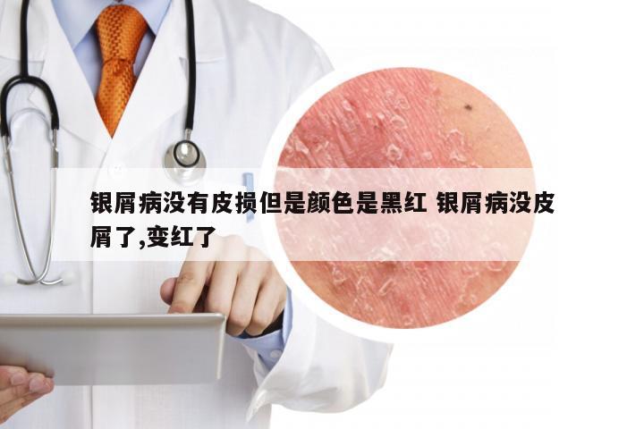 银屑病没有皮损但是颜色是黑红 银屑病没皮屑了,变红了