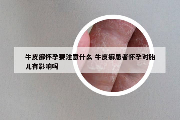 牛皮癣怀孕要注意什么 牛皮癣患者怀孕对胎儿有影响吗
