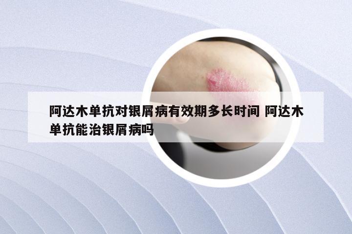 阿达木单抗对银屑病有效期多长时间 阿达木单抗能治银屑病吗