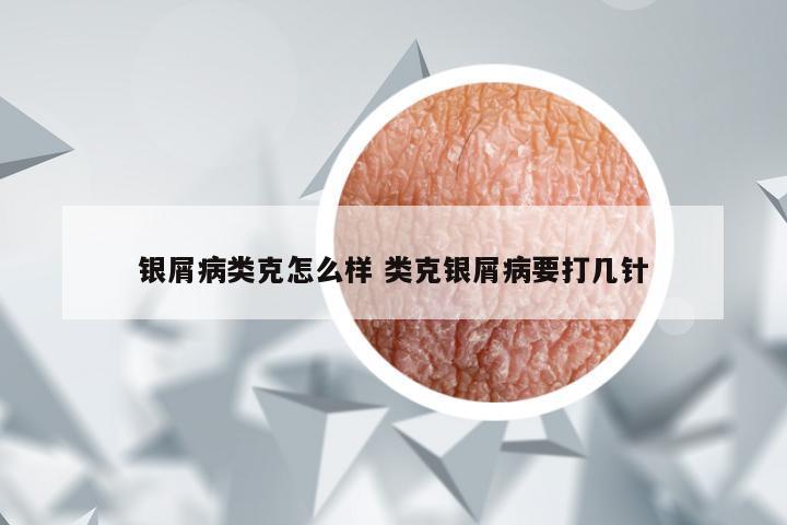 银屑病类克怎么样 类克银屑病要打几针