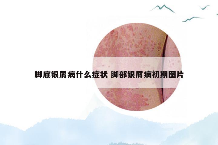 脚底银屑病什么症状 脚部银屑病初期图片
