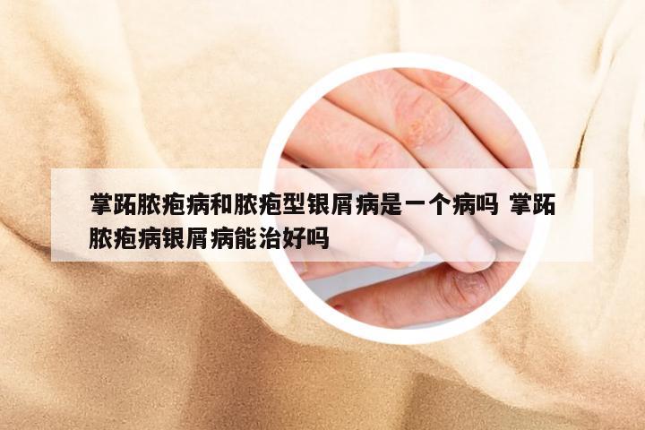 掌跖脓疱病和脓疱型银屑病是一个病吗 掌跖脓疱病银屑病能治好吗