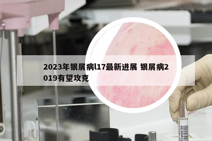 2023年银屑病l17最新进展 银屑病2019有望攻克