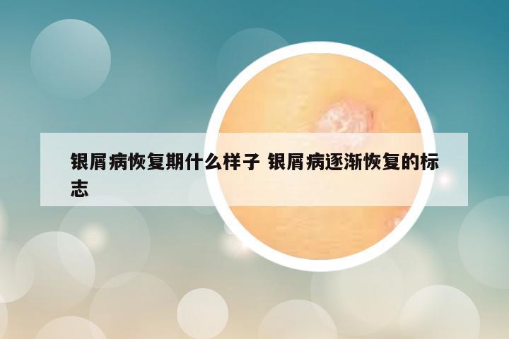 银屑病恢复期什么样子 银屑病逐渐恢复的标志