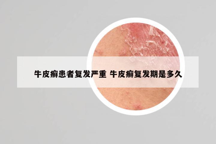 牛皮癣患者复发严重 牛皮癣复发期是多久