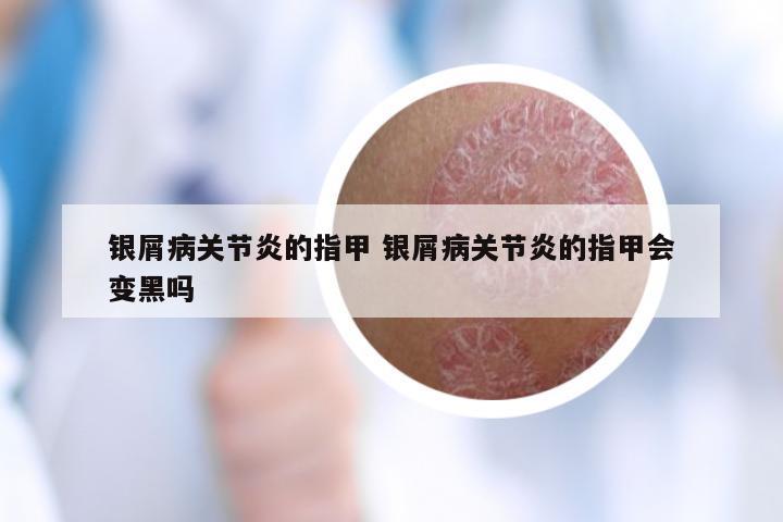 银屑病关节炎的指甲 银屑病关节炎的指甲会变黑吗
