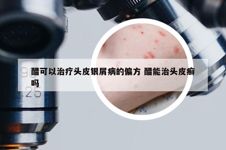 醋可以治疗头皮银屑病的偏方 醋能治头皮癣吗