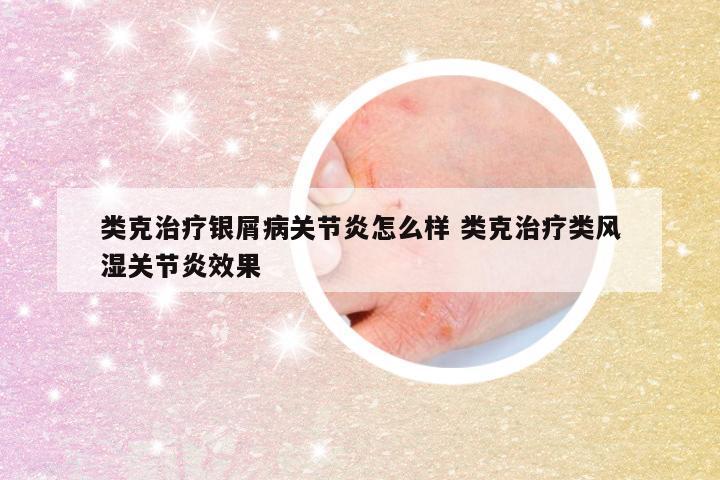 类克治疗银屑病关节炎怎么样 类克治疗类风湿关节炎效果