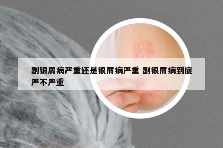 副银屑病严重还是银屑病严重 副银屑病到底严不严重