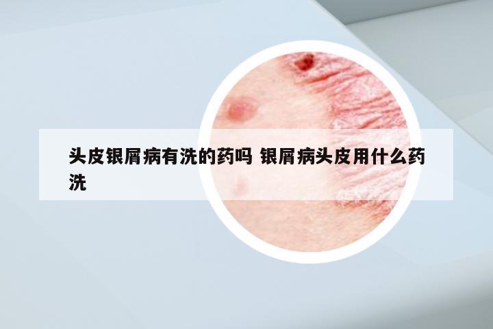 头皮银屑病有洗的药吗 银屑病头皮用什么药洗