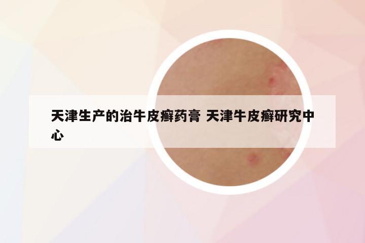 天津生产的治牛皮癣药膏 天津牛皮癣研究中心