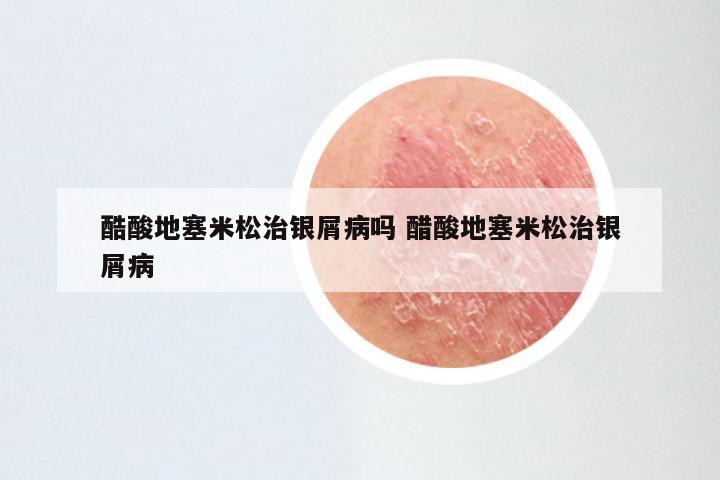 酷酸地塞米松治银屑病吗 醋酸地塞米松治银屑病