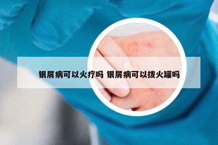 银屑病可以火疗吗 银屑病可以拨火罐吗