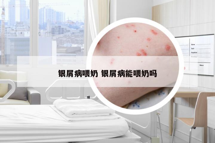 银屑病喂奶 银屑病能喂奶吗