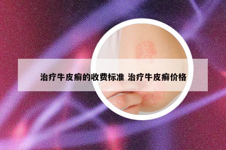 治疗牛皮癣的收费标准 治疗牛皮癣价格