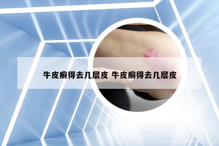 牛皮癣得去几层皮 牛皮癣得去几层皮