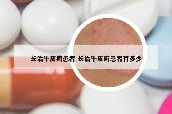 长治牛皮癣患者 长治牛皮癣患者有多少