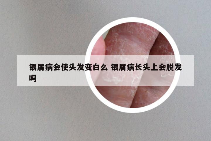 银屑病会使头发变白么 银屑病长头上会脱发吗