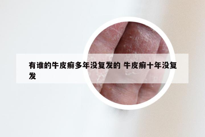 有谁的牛皮癣多年没复发的 牛皮癣十年没复发