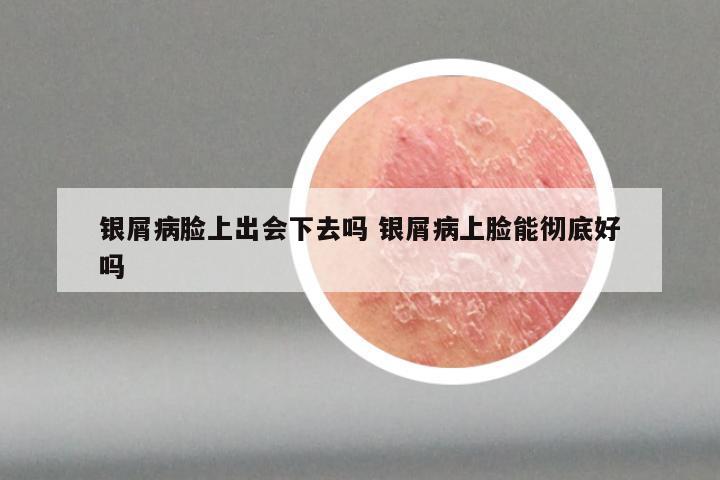 银屑病脸上出会下去吗 银屑病上脸能彻底好吗