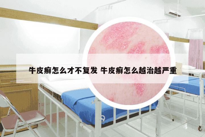 牛皮癣怎么才不复发 牛皮癣怎么越治越严重