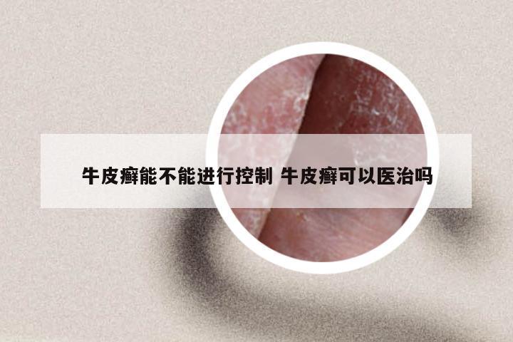 牛皮癣能不能进行控制 牛皮癣可以医治吗