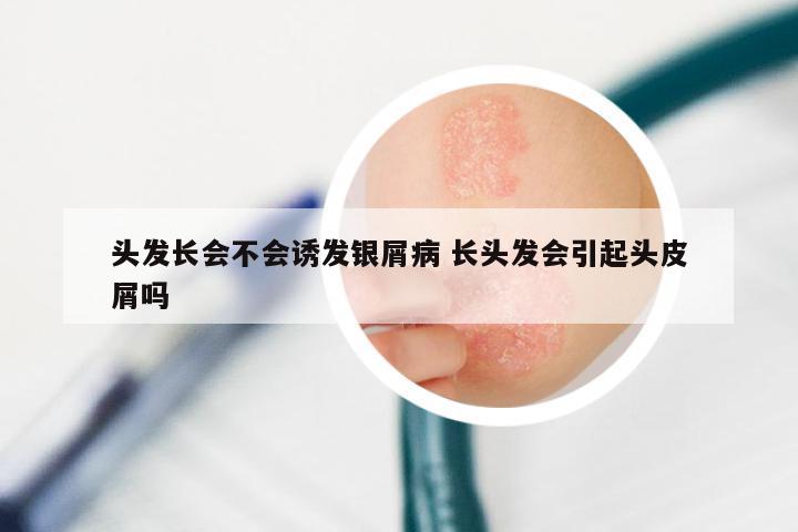 头发长会不会诱发银屑病 长头发会引起头皮屑吗